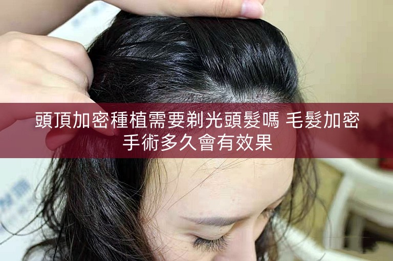 頭頂加密種植需要剃光頭髮嗎 毛髮加密手術多久會有效果