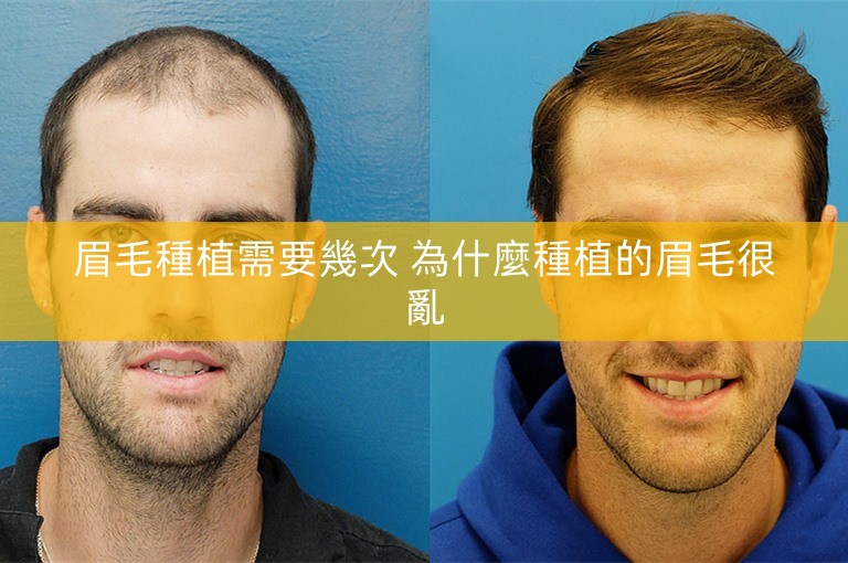 眉毛種植需要幾次 為什麼種植的眉毛很亂