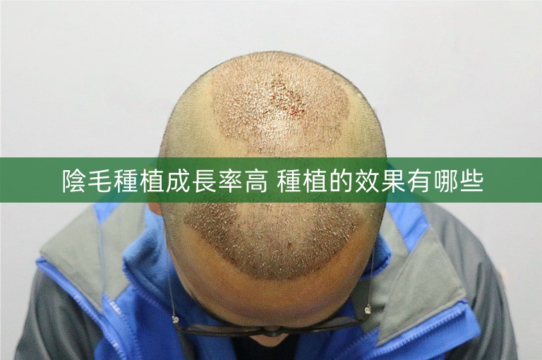 陰毛種植成長率高 種植的效果有哪些