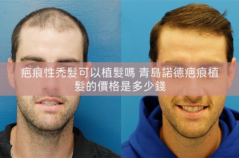 疤痕性禿髮可以植髮嗎 青島諾德疤痕植髮的價格是多少錢