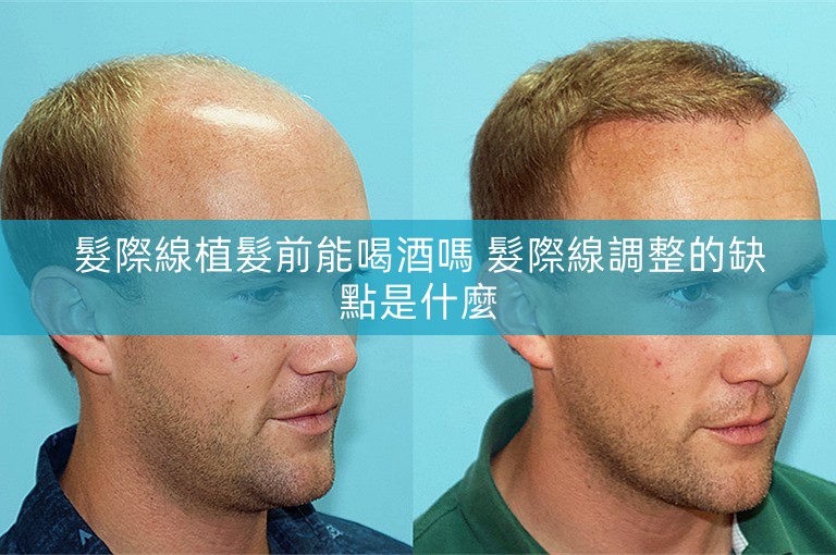 髮際線植髮前能喝酒嗎 髮際線調整的缺點是什麼