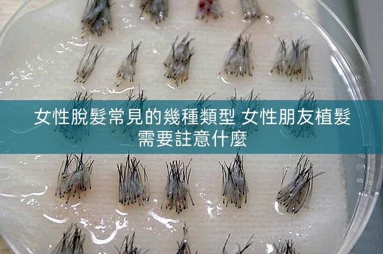 女性脫髮常見的幾種類型 女性朋友植髮需要註意什麼