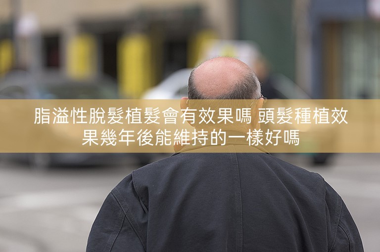 脂溢性脫髮植髮會有效果嗎 頭髮種植效果幾年後能維持的一樣好嗎