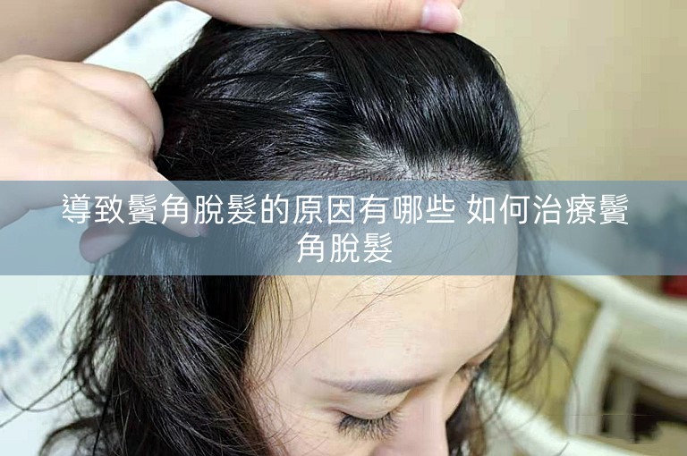 導致鬢角脫髮的原因有哪些 如何治療鬢角脫髮