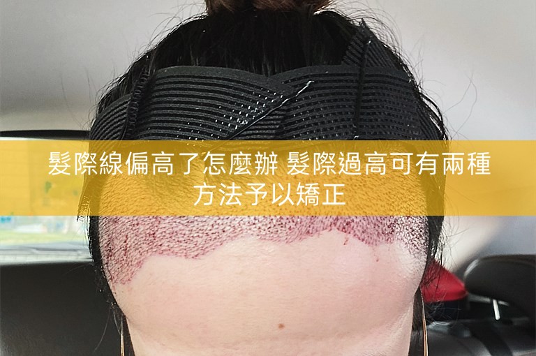 髮際線偏高了怎麼辦 髮際過高可有兩種方法予以矯正 髮際線偏高了怎麼辦 髮際過高可有兩種方法予以矯正