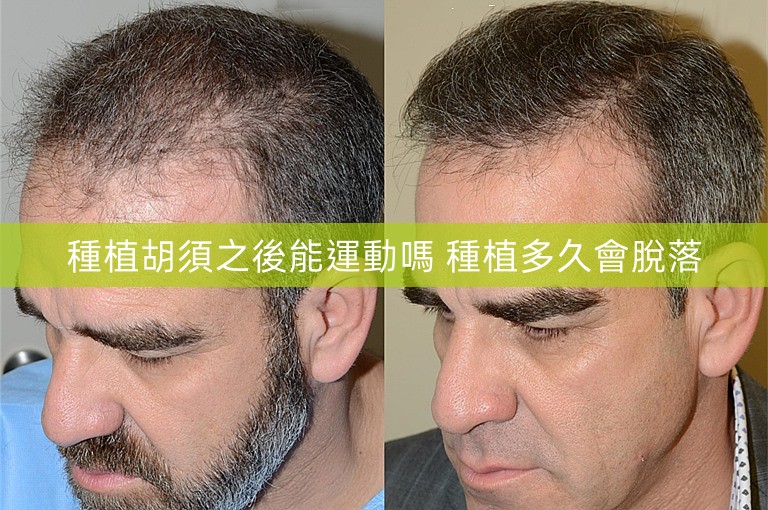 種植胡須之後能運動嗎 種植多久會脫落
