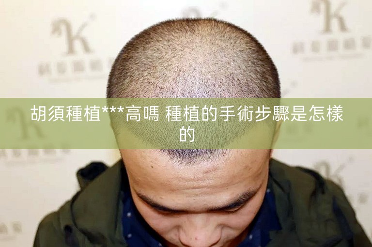 胡須種植***高嗎 種植的手術步驟是怎樣的 胡須種植***高嗎 種植的手術步驟是怎樣的