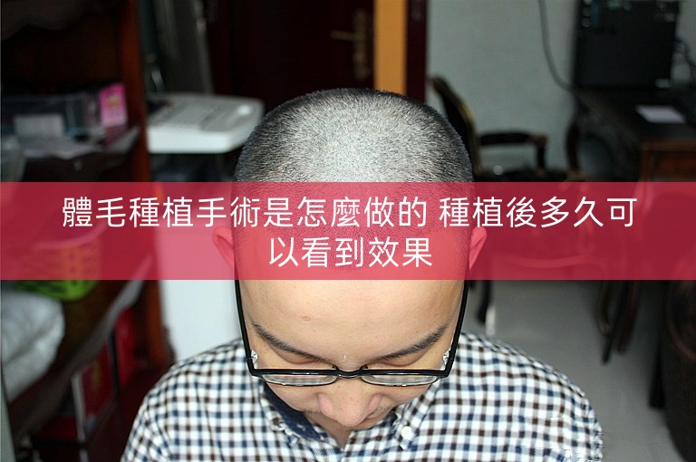 體毛種植手術是怎麼做的 種植後多久可以看到效果