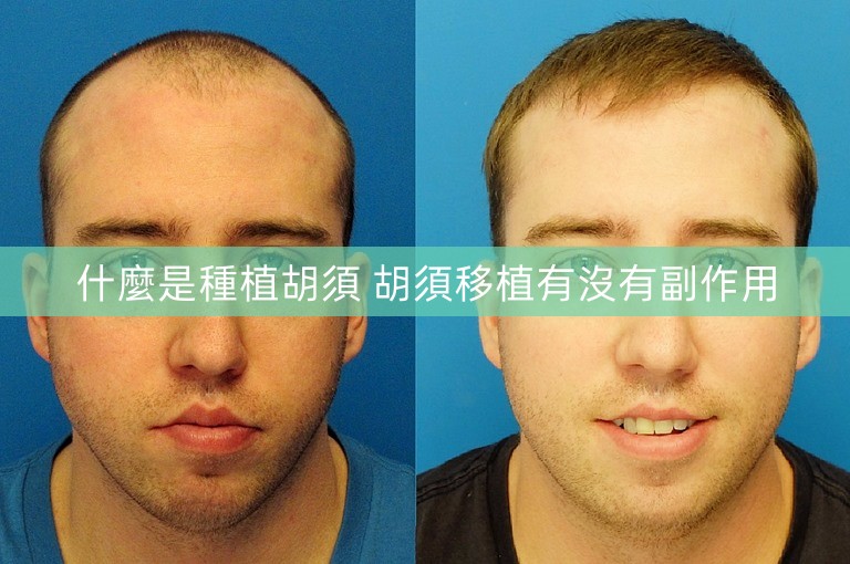 什麼是種植胡須 胡須移植有沒有副作用