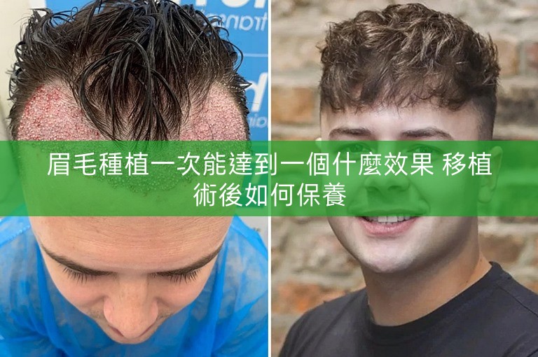 眉毛種植一次能達到一個什麼效果 移植術後如何保養
