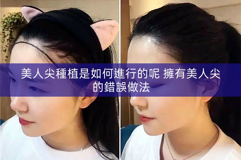 美人尖種植是如何進行的呢 擁有美人尖的錯誤做法