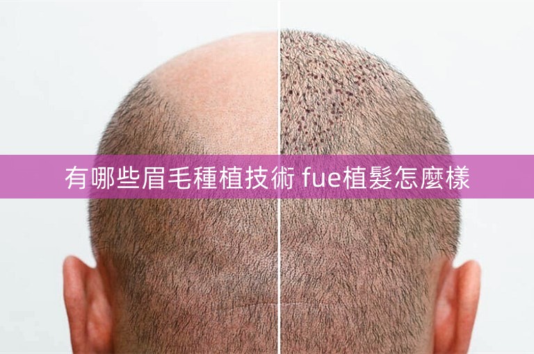 有哪些眉毛種植技術 fue植髮怎麼樣
