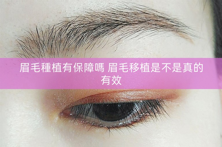 眉毛種植有保障嗎 眉毛移植是不是真的有效