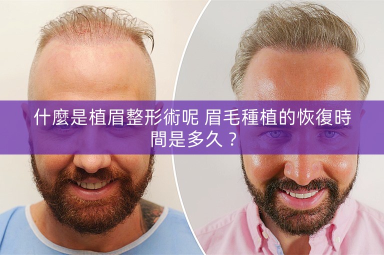 什麼是植眉整形術呢 眉毛種植的恢復時間是多久？