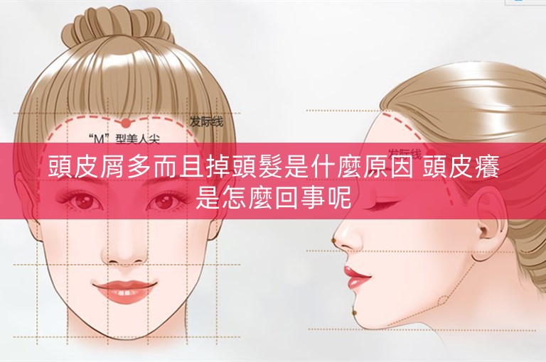 頭皮屑多而且掉頭髮是什麼原因 頭皮癢是怎麼回事呢