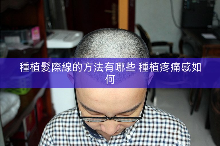 種植髮際線的方法有哪些 種植疼痛感如何 種植髮際線的方法有哪些 種植疼痛感如何