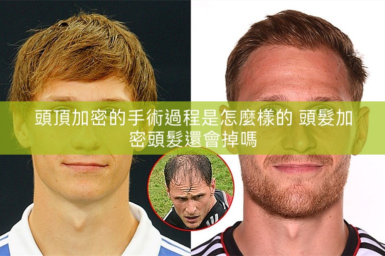 頭頂加密的手術過程是怎麼樣的 頭髮加密頭髮還會掉嗎