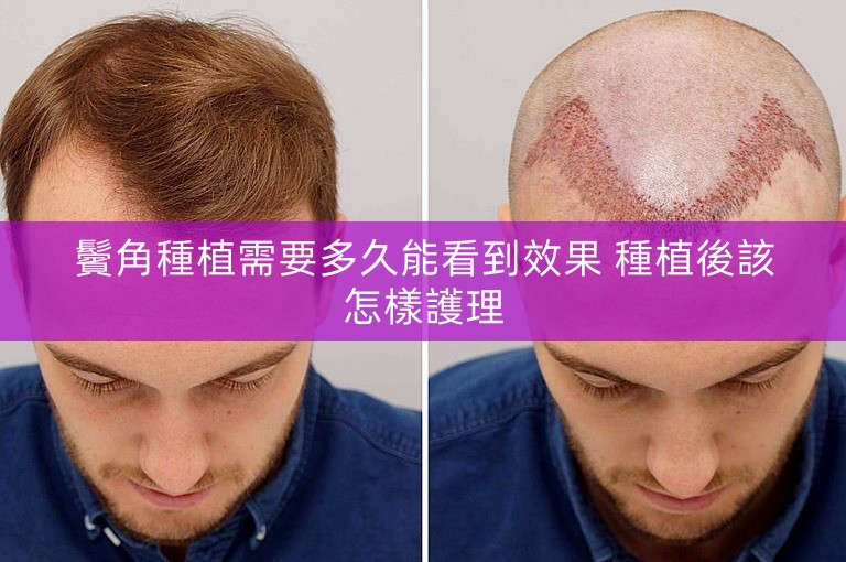 鬢角種植需要多久能看到效果 種植後該怎樣護理