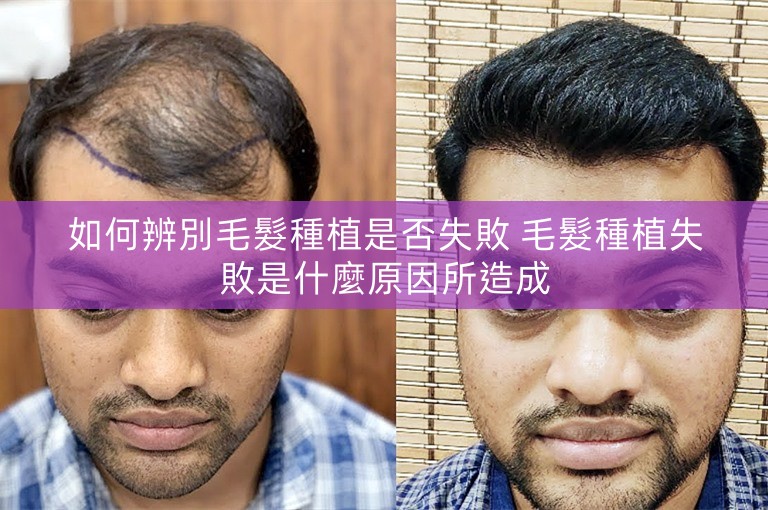如何辨別毛髮種植是否失敗 毛髮種植失敗是什麼原因所造成