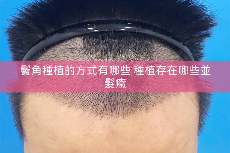 鬢角種植的方式有哪些 種植存在哪些並髮癥