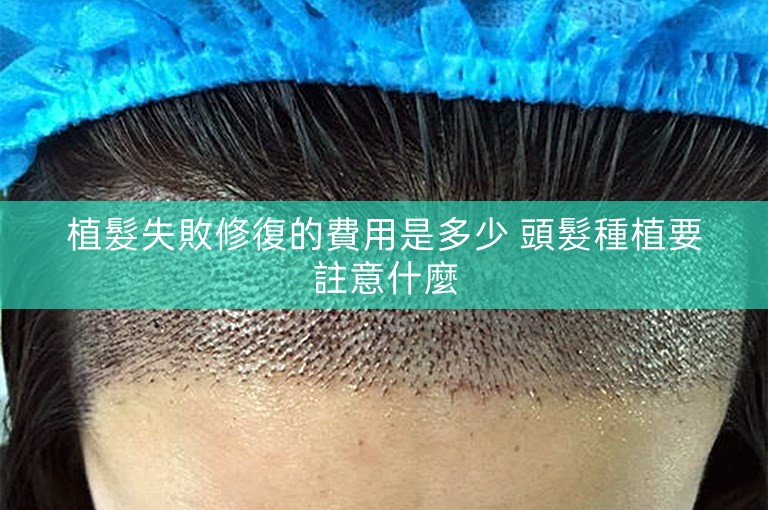 植髮失敗修復的費用是多少 頭髮種植要註意什麼