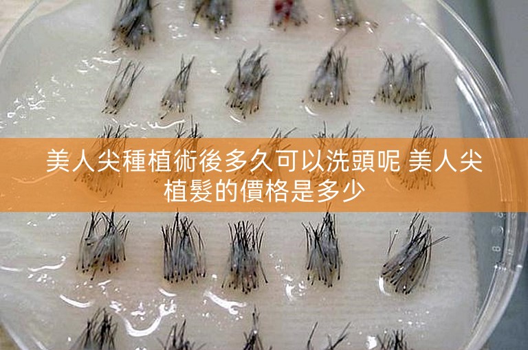 美人尖種植術後多久可以洗頭呢 美人尖植髮的價格是多少