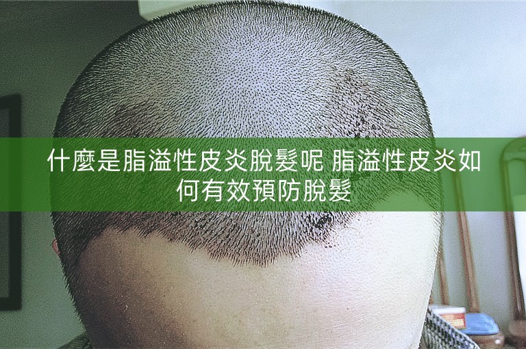 什麼是脂溢性皮炎脫髮呢 脂溢性皮炎如何有效預防脫髮