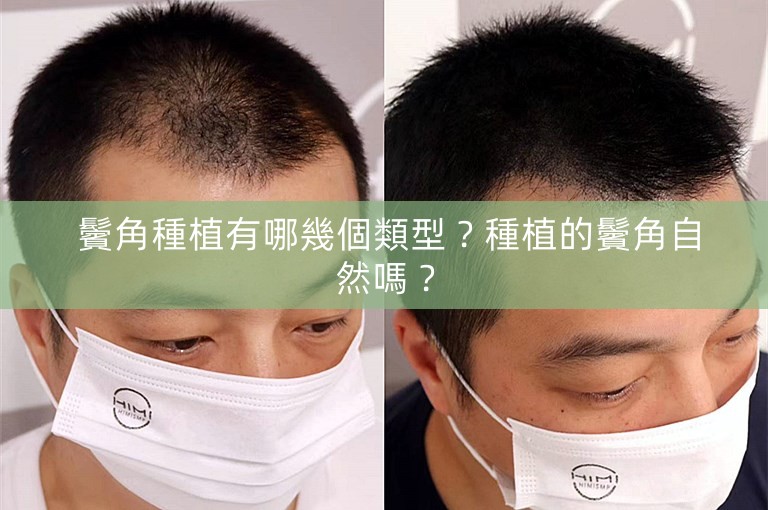  鬢角種植有哪幾個類型？種植的鬢角自然嗎？