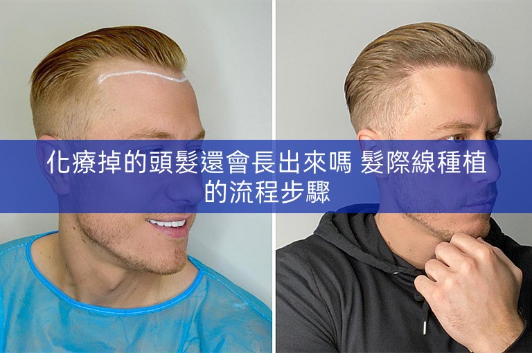 化療掉的頭髮還會長出來嗎 髮際線種植的流程步驟 化療掉的頭髮還會長出來嗎 髮際線種植的流程步驟