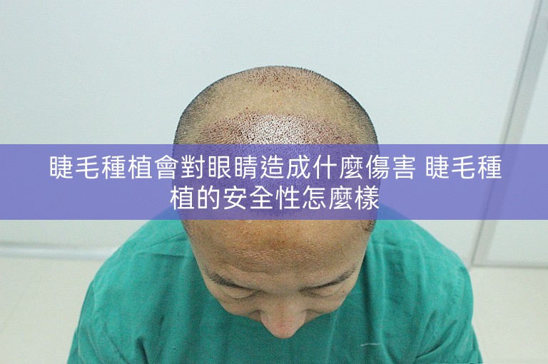 睫毛種植會對眼睛造成什麼傷害 睫毛種植的安全性怎麼樣