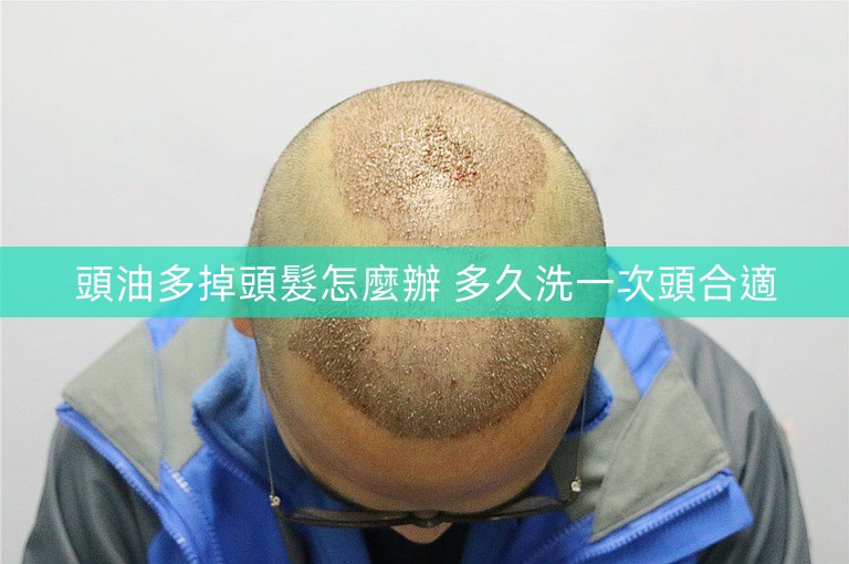 頭油多掉頭髮怎麼辦 多久洗一次頭合適