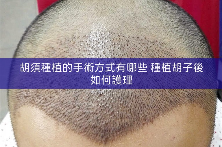 胡須種植的手術方式有哪些 種植胡子後如何護理 胡須種植的手術方式有哪些 種植胡子後如何護理