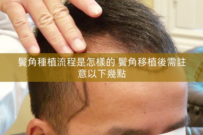 鬢角種植流程是怎樣的 鬢角移植後需註意以下幾點
