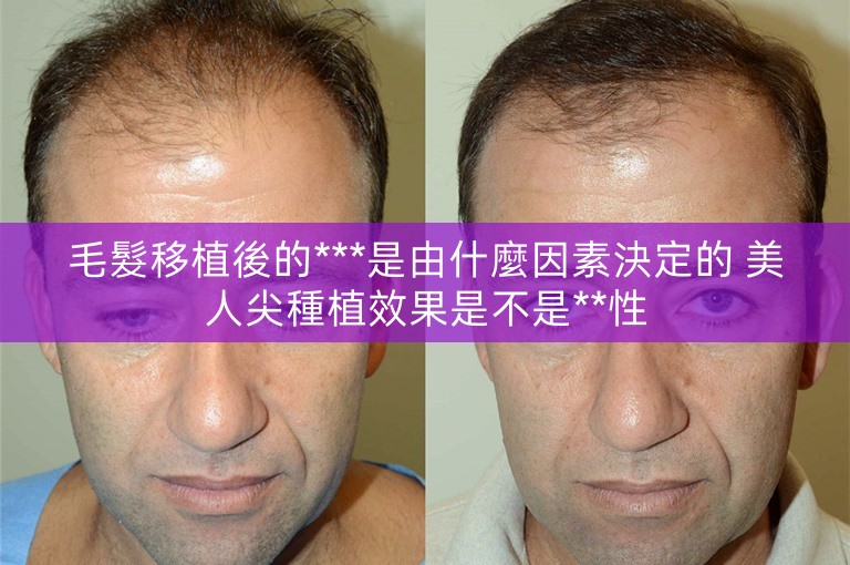 毛髮移植後的***是由什麼因素決定的 美人尖種植效果是不是**性