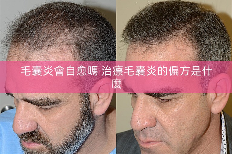 毛囊炎會自愈嗎 治療毛囊炎的偏方是什麼
