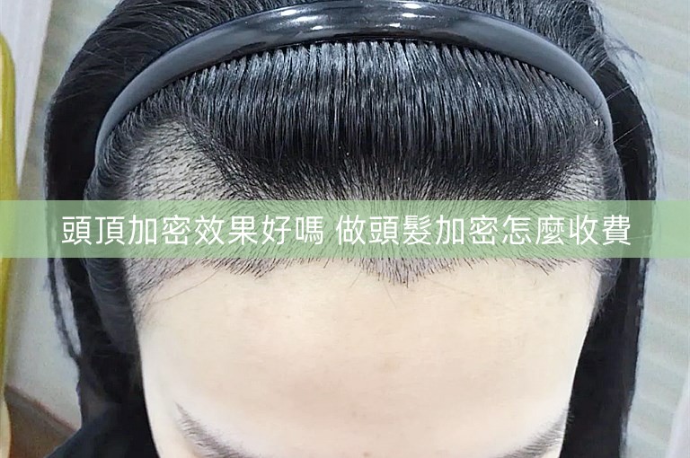 頭頂加密效果好嗎 做頭髮加密怎麼收費