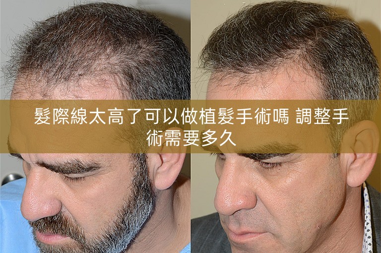 髮際線太高了可以做植髮手術嗎 調整手術需要多久