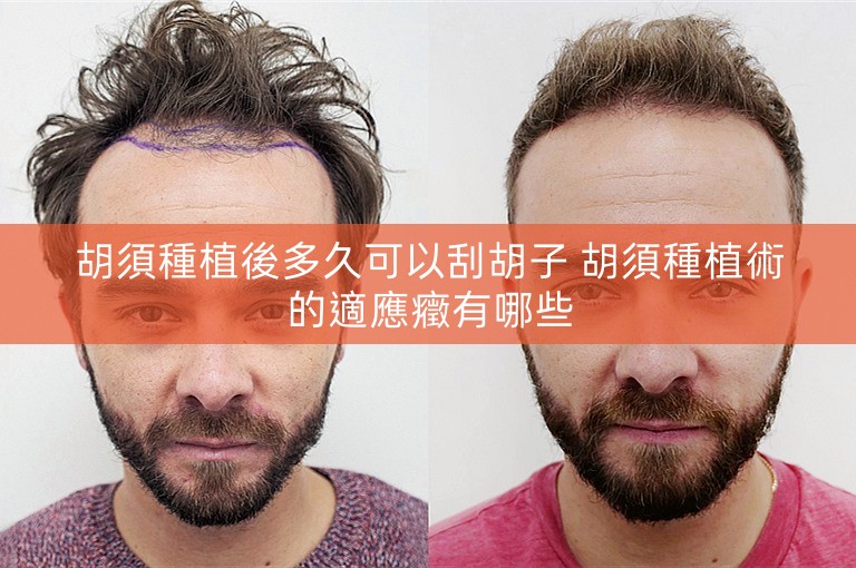 胡須種植後多久可以刮胡子 胡須種植術的適應癥有哪些