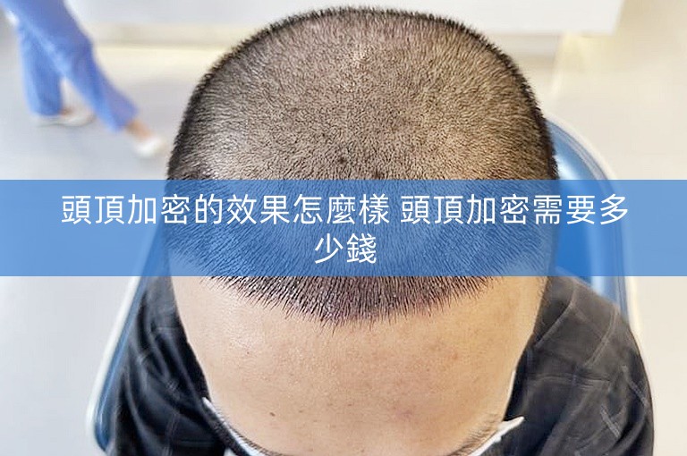 頭頂加密的效果怎麼樣 頭頂加密需要多少錢