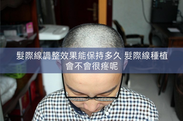 髮際線調整效果能保持多久 髮際線種植會不會很疼呢