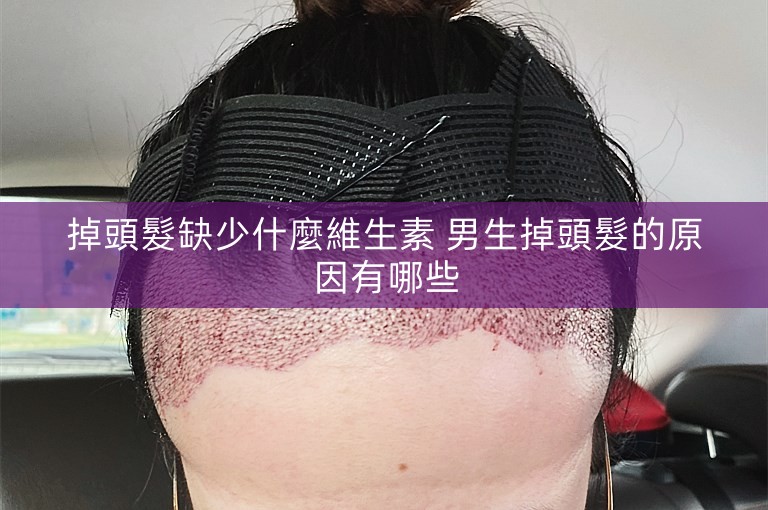 掉頭髮缺少什麼維生素 男生掉頭髮的原因有哪些