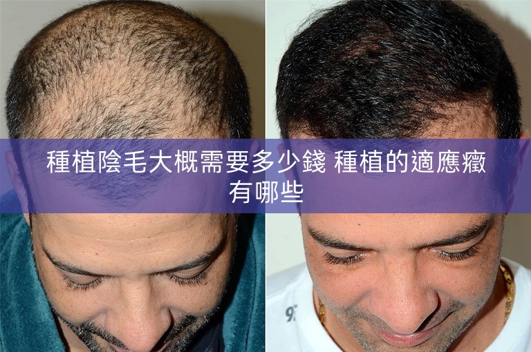 種植陰毛大概需要多少錢 種植的適應癥有哪些