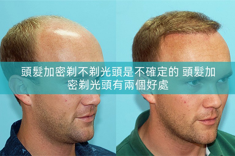 頭髮加密剃不剃光頭是不確定的 頭髮加密剃光頭有兩個好處
