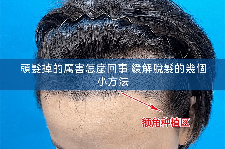 頭髮掉的厲害怎麼回事 緩解脫髮的幾個小方法