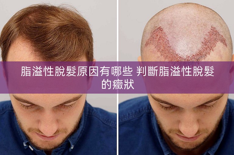 脂溢性脫髮原因有哪些 判斷脂溢性脫髮的癥狀