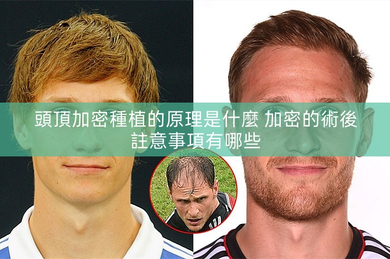 頭頂加密種植的原理是什麼 加密的術後註意事項有哪些