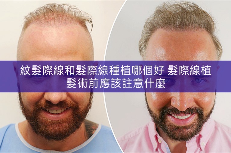 紋髮際線和髮際線種植哪個好 髮際線植髮術前應該註意什麼 紋髮際線和髮際線種植哪個好 髮際線植髮術前應該註意什麼
