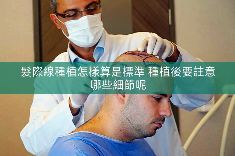 髮際線種植怎樣算是標準 種植後要註意哪些細節呢