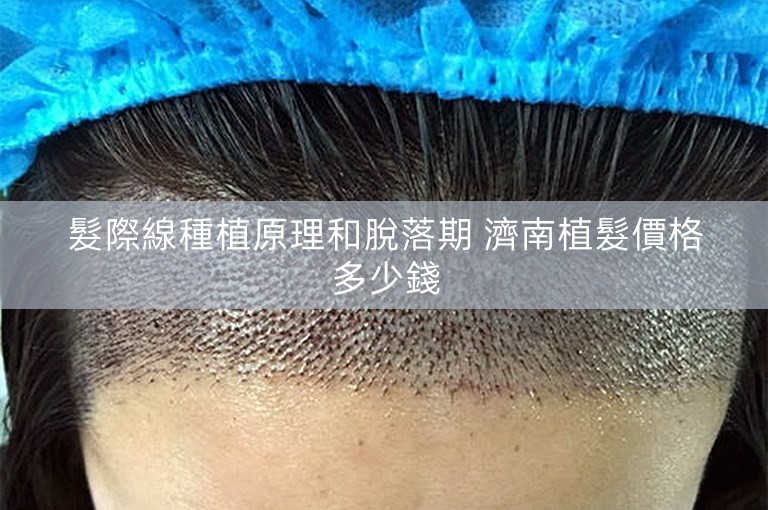 髮際線種植原理和脫落期 濟南植髮價格多少錢