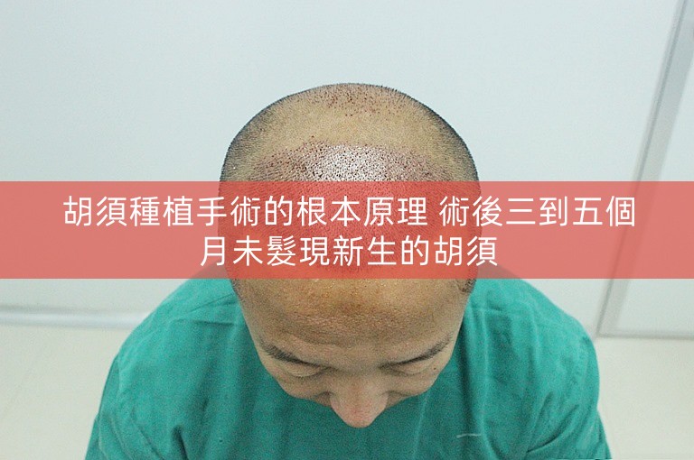 胡須種植手術的根本原理 術後三到五個月未髮現新生的胡須